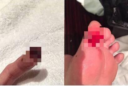 包装破了搬运容易受伤